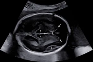 Biometria fetal monitorização pré-natal